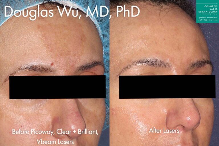 Picoway, Clear+Brilliant, Vbeam lasers used to treat melasma on forehead by Dr. Wu. After treatment melasma and red spot are gone and forehead looks clearer.