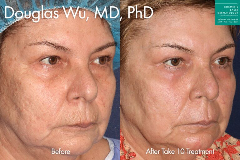 Take 10 treatment to rejuvenate the appearance by Dr. Wu. After treatment, skin is smoother, brighter, and more youthful.