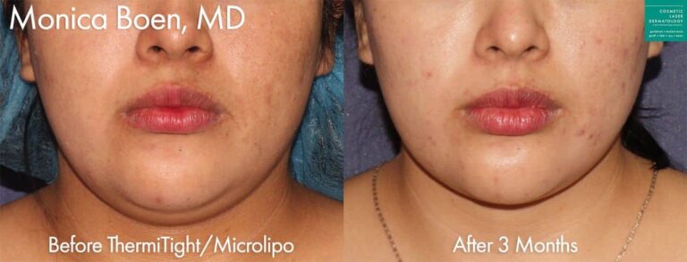 ThermiTight and Micro-lipo to contour the chin and jawline by Dr. Boen. Treatment removes submental fat and defines the jawline.