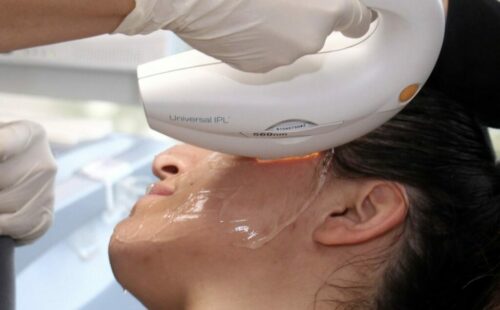 patient receiving a cosmetic laser dermatology treatment in San Diego, CA