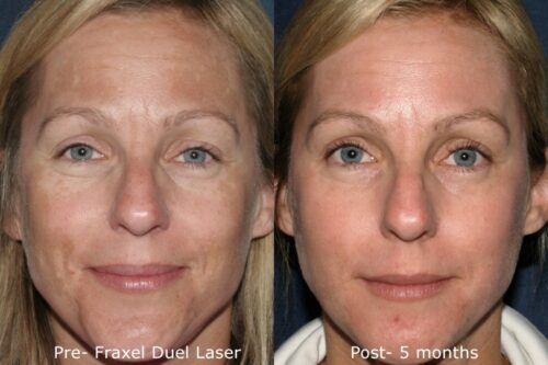 facial laser treatment before and after results in San Diego, CA