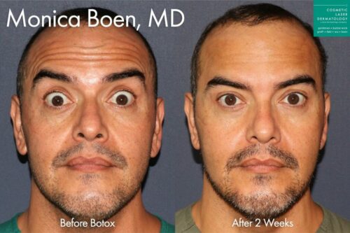 injectables treatment results in San Diego, CA