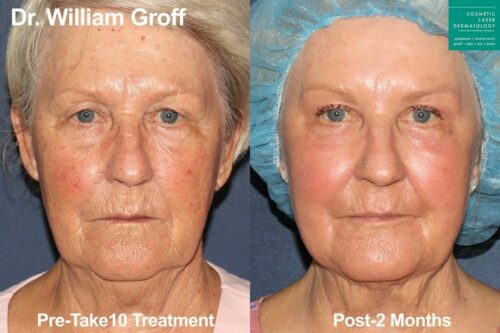 Take10 treatment before and after results from patient in San Diego