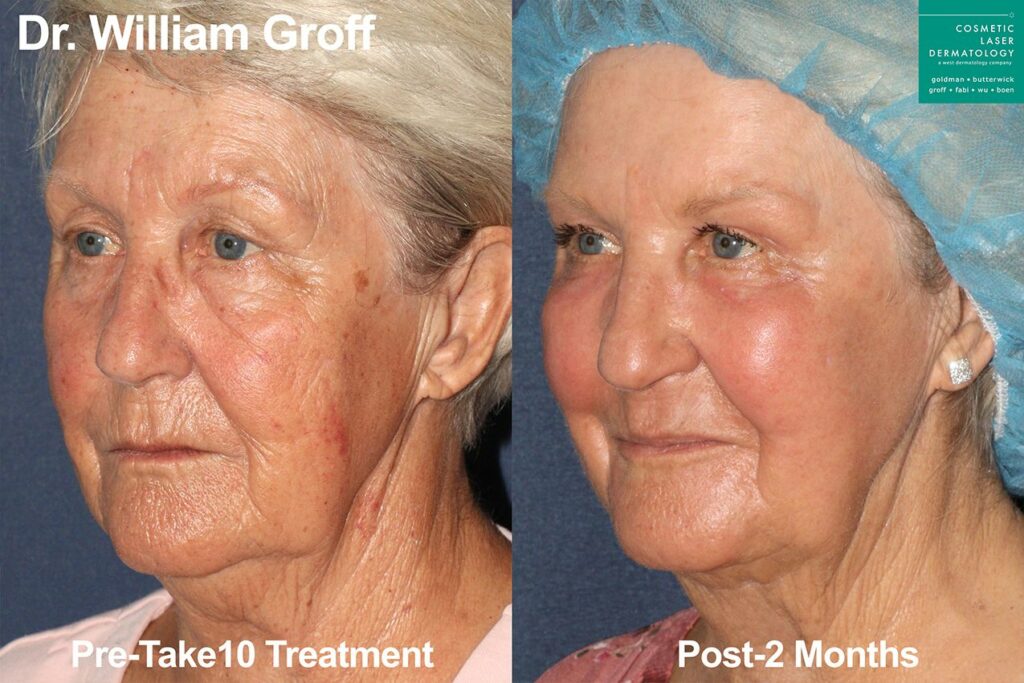 before and after results from a combination cosmetic treatment in San Diego