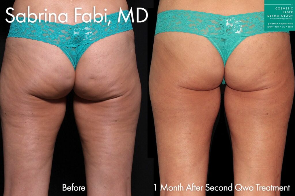 Qwo injectable cellulite treatment before and after results in San Diego, CA