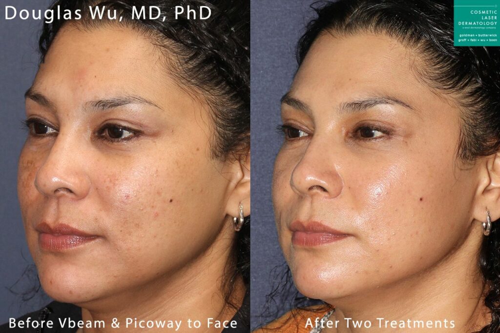 pigmentation treatment results in San Diego, CA