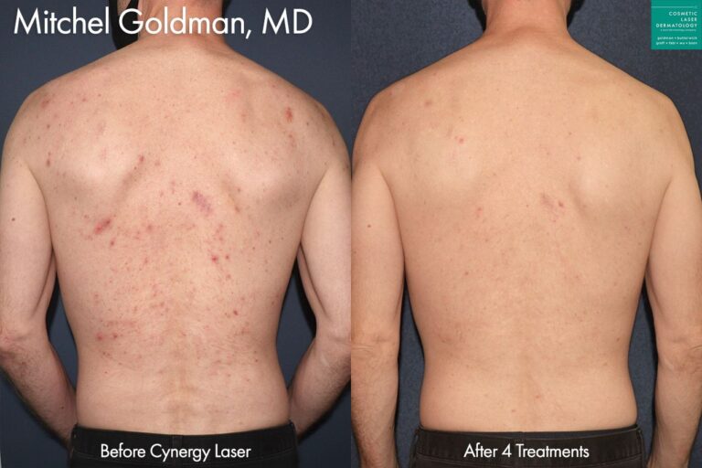 Cynergy laser to treat back acne by Dr. Goldman. After four treatments, acne is minimized and skin is visibly clearer.