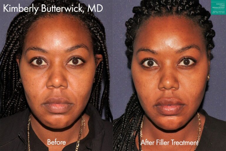 Combination filler treatment to enhance the facial contours by Dr. Butterwick. After treatment, cheeks are lifted and jawline looks more defined.