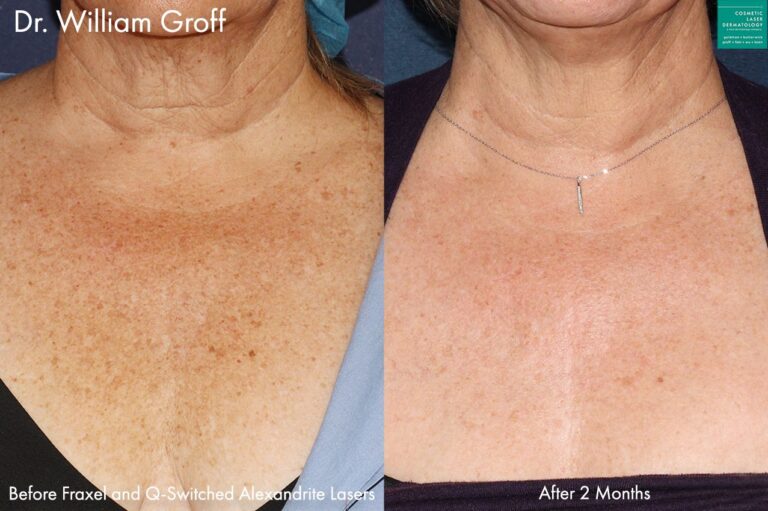 Fraxel and Alexandrite lasers to treat sun damage on chest by Dr. Groff. Two months after treatment, brown spots are minimized and skin is visibly smoother and clearer.