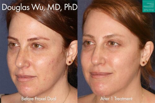 Fraxel Dual for skin rejuvenation by Dr. Wu. After treatment, skin is smoother and sun damage is minimized.