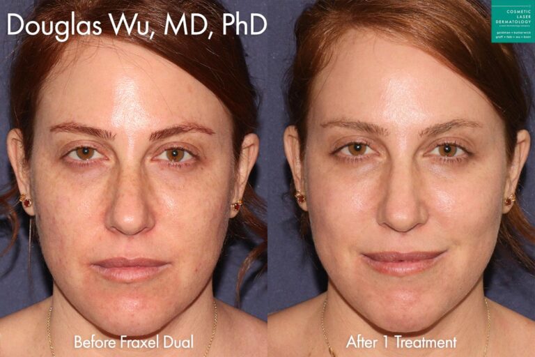 Fraxel Dual for skin rejuvenation by Dr. Wu. After treatment, skin is smoother and sun damage is minimized.