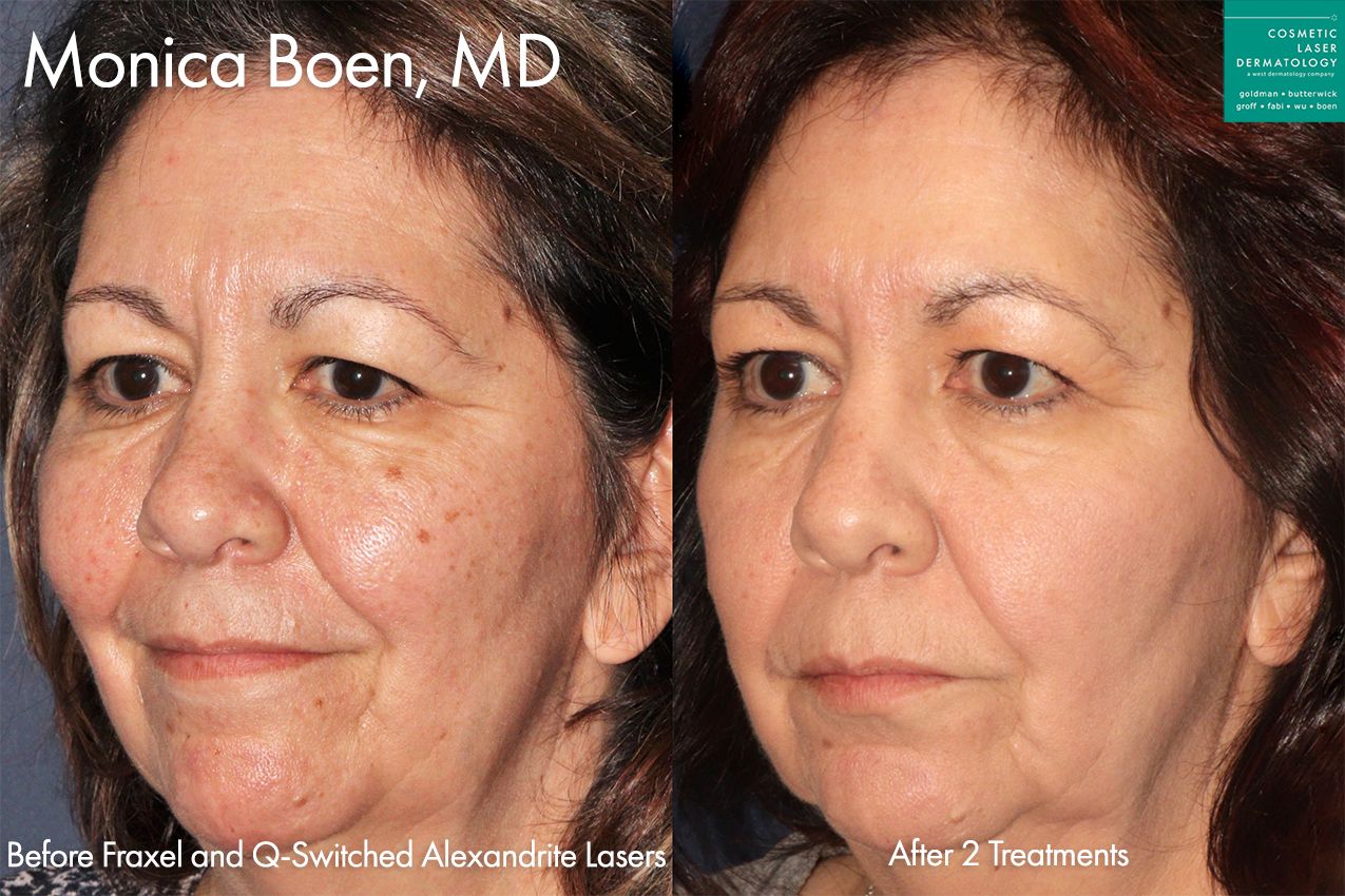 Fraxel and Alexandrite lasers to rejuvenate the skin and treat sun damage by Dr. Boen. After treatment, brown spots are gone and the skin is smoother and more youthful.