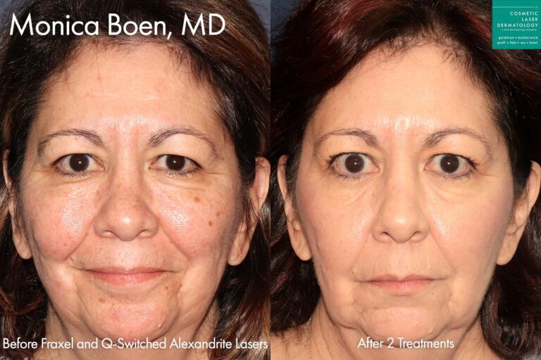Fraxel and Alexandrite lasers to rejuvenate the skin and treat sun damage by Dr. Boen. After treatment, brown spots are gone and the skin is smoother and more youthful.