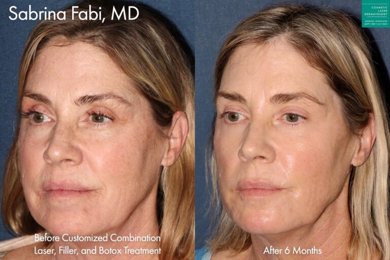Laser, filler and Botox treatment to rejuvenate the face by Dr. Fabi. After combination treatment, skin is smoother, lines are reduced, and the appearance is more youthful overall.