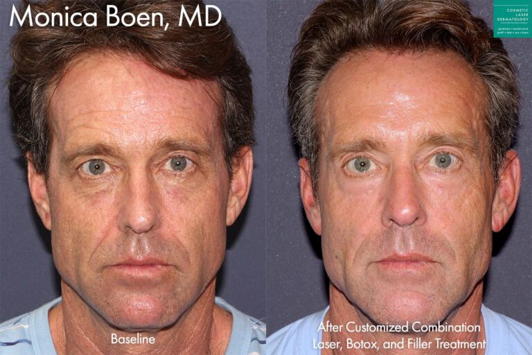 Laser, Botox, and filler to rejuvenate the face by Dr. Boen. After treatment, skin is smoother, youthful volume is restored and there is a visible reduction in wrinkles.