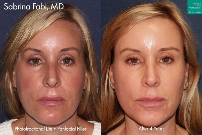 Laser and filler to rejuvenate the face, four years later by Dr. Fabi. After treatment, skin is smoother with fewer fine lines, facial contours are improved.