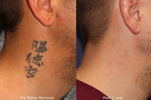 laser tattoo removal treatment results in San Diego, CA