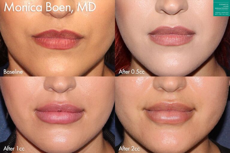 Lip filler in four stages to plump up the lips by Dr. Boen. After each treatment, lips become progressively bigger while maintaining their natural appearance.
