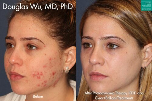 Photodynamic therapy and Clear+Brilliant laser to treat active acne by Dr. Wu. After treatment, skin is visibly smoother and clearer.