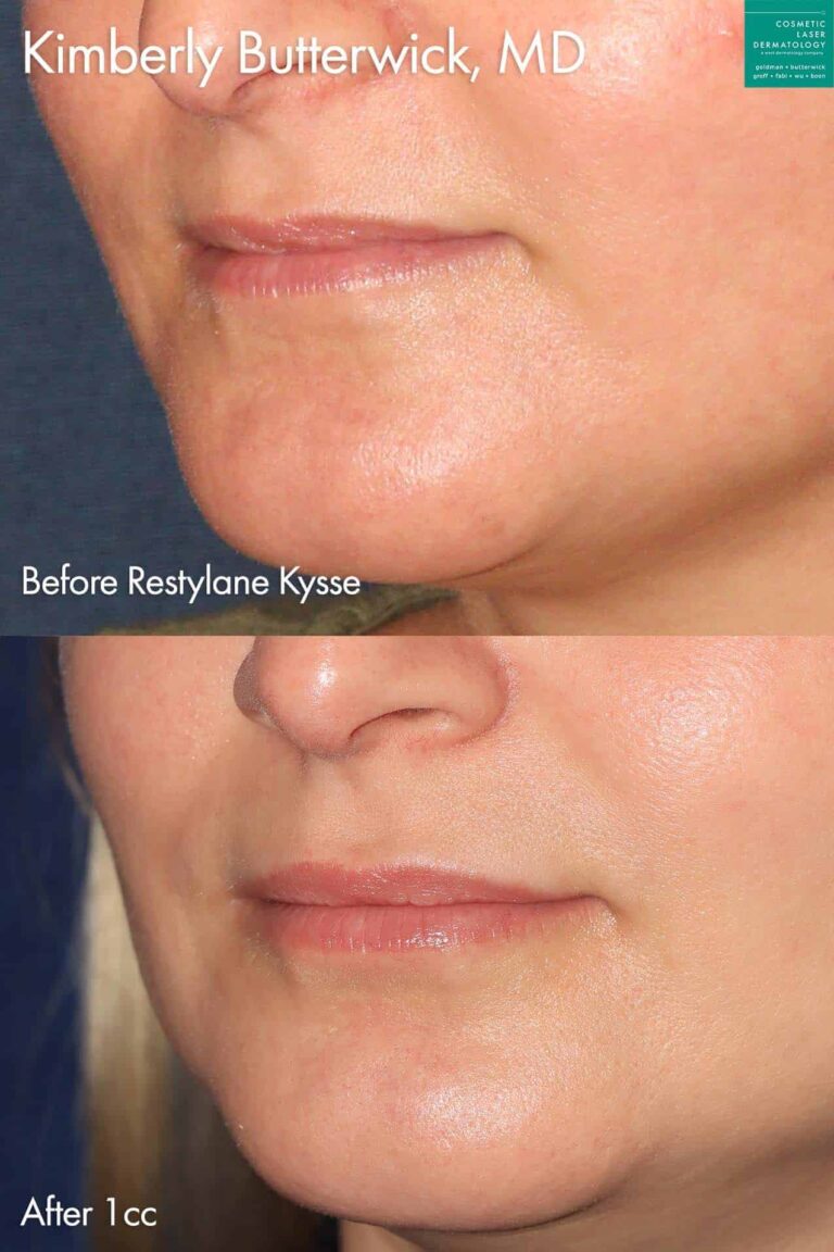 Restylane Kysse to plump up the lips by Dr. Butterwick. After treatment, lips are fuller and more proportionate.