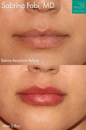 Restylane Refyne to plump up the lips by Dr. Fabi. After injections, lips are fuller and shapelier.