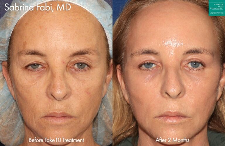 Take 10 to create a more youthful appearance by Dr. Fabi. After treatment, skin is smoother and softer and fine lines and sun damage are visibly reduced.