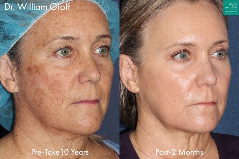 Take 10 treatment to reverse aging signs by Dr. Groff. Eight months after treatment, skin is noticeably smoother with fewer wrinkles and pigmentation issues.