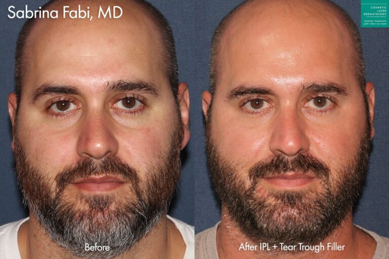IPL and tear trough filler to rejuvenate the face of a male patient by Dr. Fabi. After treatment, skin is healthier and smoother and area under the eyes is visibly refreshed.