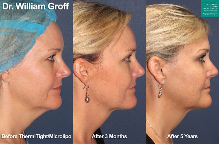 ThermiTight and microlipo to sculpt the chin and jawline by Dr. Groff. Five years after treatment, submental fat is still gone and jawline is more defined.