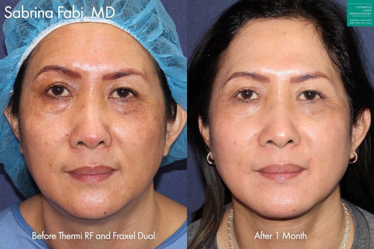 ThermiRF and Fraxel Dual for full skin rejuvenation by Dr. Fabi. After treatment, pigmentation is minimized and skin is much smoother.