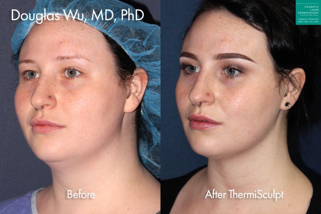 Female patient profile before and after thermisculpt for jawline contouring in San Diego