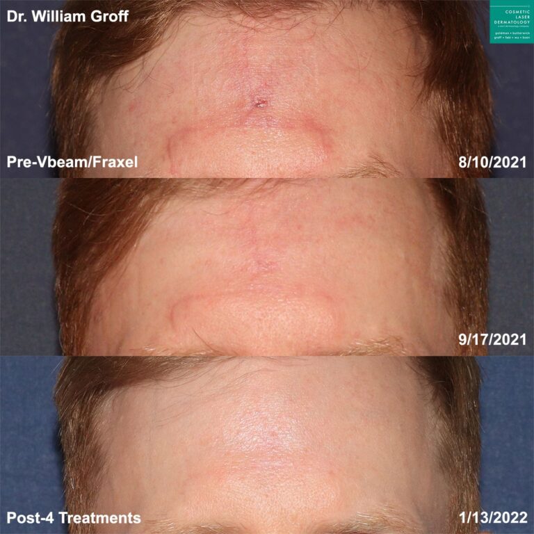 Vbeam and Fraxel lasers to treat scar on forehead by Dr. Groff. After four treatments, scar is barely visible.