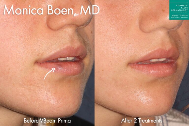 Vbeam laser used to treat angioma on lip by Dr. Boen. After treatment purple bump is gone from lower lip.