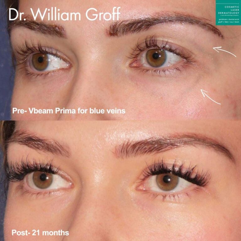 Vbeam Prima to remove blue vein from under eye by Dr. Groff. After treatment, visible vein is gone.