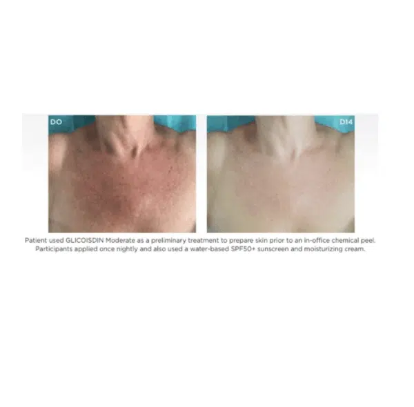 Isdin Glicoisdin Moderate - Image 3