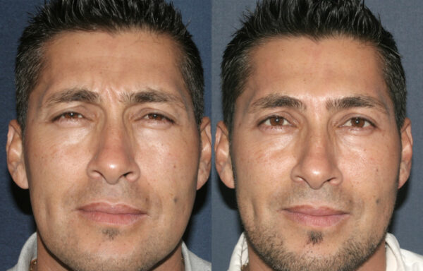 Botox before and after results on a male patient in San Diego, CA