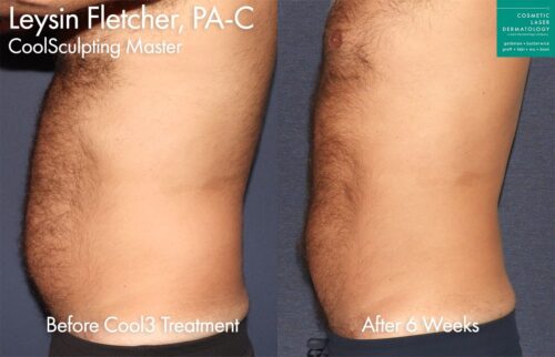 before and after results from a non-surgical body contouring treatment in San Diego