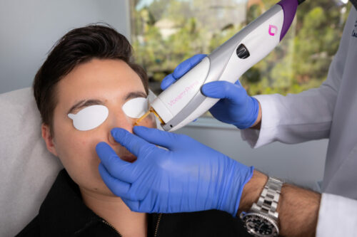 patient receiving a Vbeam Prima laser treatment in San Diego