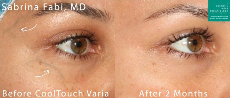 under eye vein treatment before and after results in San Diego