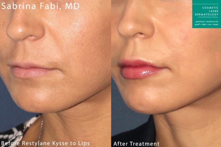 lip filler before and after results in San Diego, CA