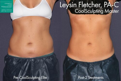 You Can Get Your Pre-Pregnancy Body Back With Body Contouring