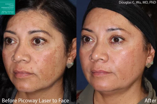 before and after results from a laser treatment to even pigmentation after pregnancy in San Diego, CA