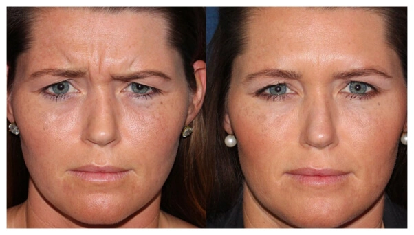 before and after results from a postpartum Botox treatment in San Diego ca