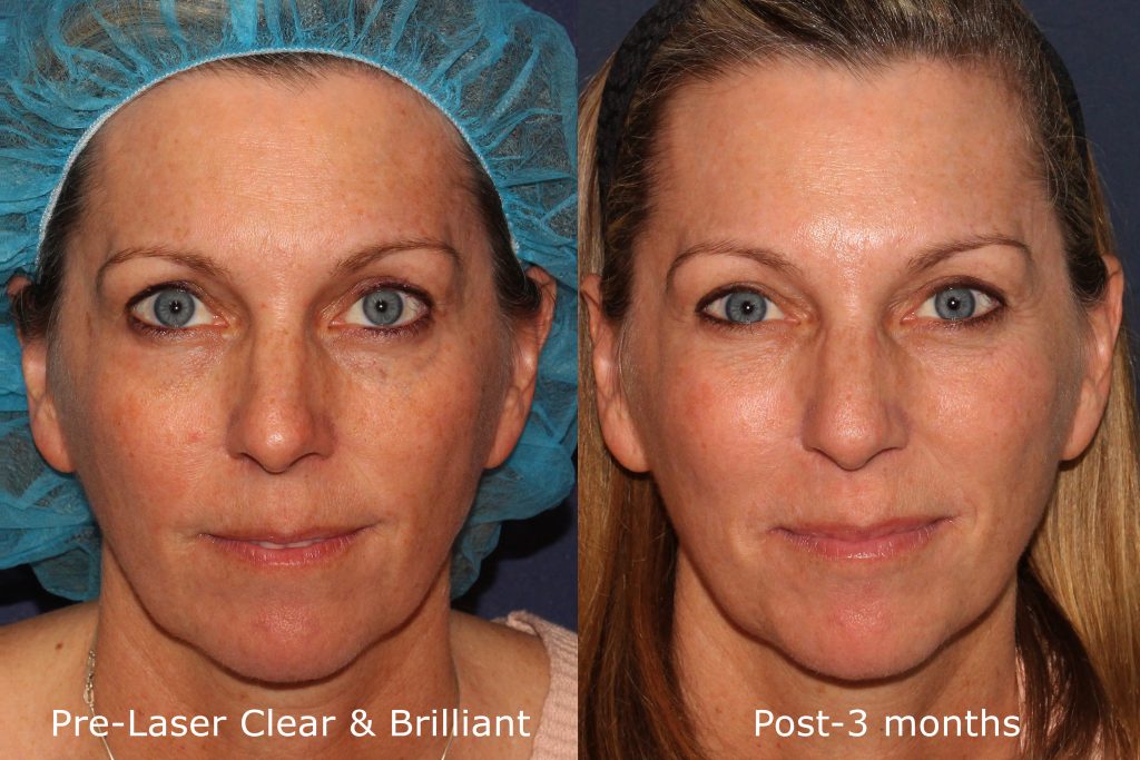 before and after results from a Clear + Brilliant treatment in San Diego, CA