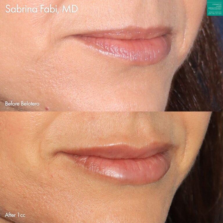 Belotero to enhance the lips of a female patient by Dr. Fabi. After treatment, lips look fuller, smoother, and more defined.