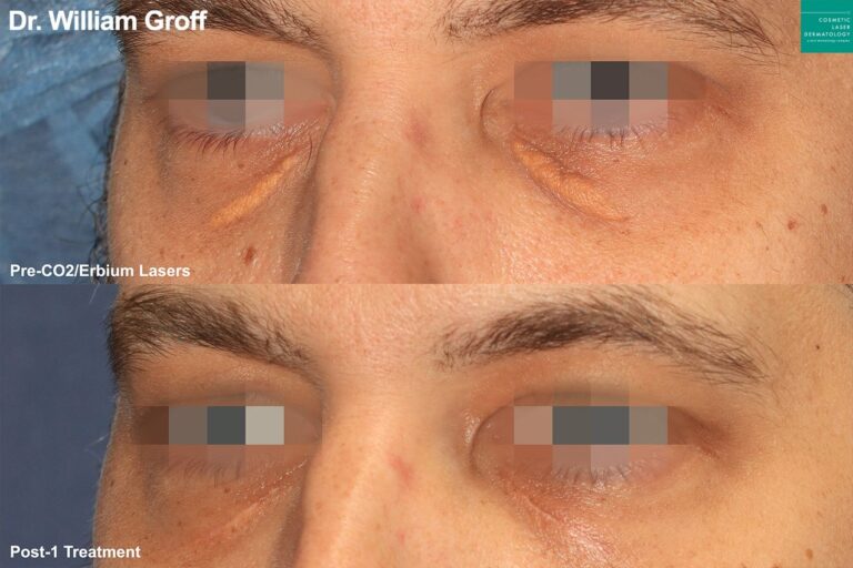 CO2 and Erbium lasers to treat Xanthelasma around the eyes by Dr. Groff. After treatment, yellow plaque areas are nearly undetectable.