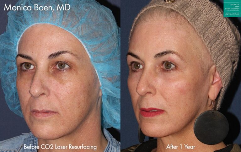 CO2 laser resurfacing to rejuvenate the appearance of a female patient by Dr. Boen. After treatment, sun damage is minimized and patient's skin looks fresher and firmer.