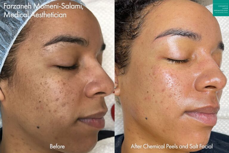 Chemical peels and salt facial to treat brown spots by Farzaneh Momeni-Salami, MA. After treatment, brown spots are reduced, pores are smaller, and skin is smoother overall.