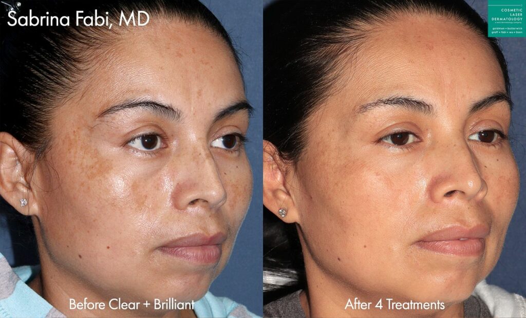 clderm Clear + Brilliant laser to treat melasma by Dr. Fabi. before and after san diego ca