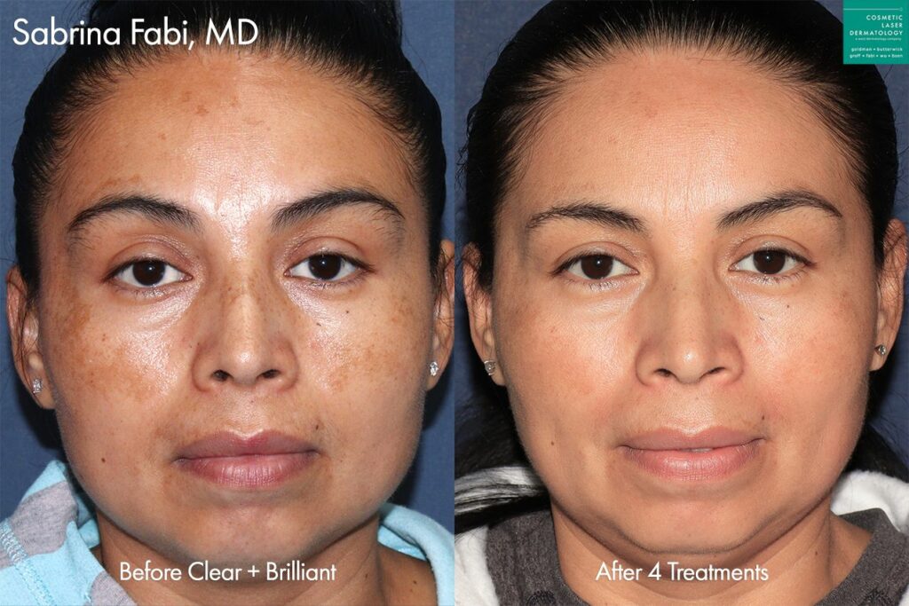 clderm Clear + Brilliant laser to treat melasma by Dr. Fabi. After 4 treatments, brown patches are virtually undetectable san diego ca